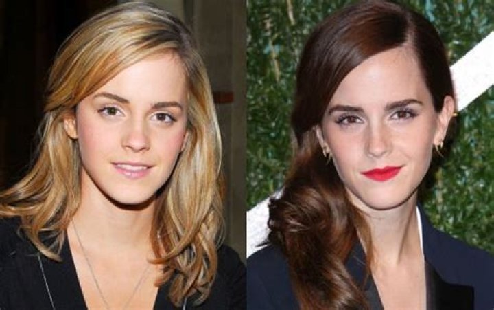 Emma Watson Plastic Surgery Before and After