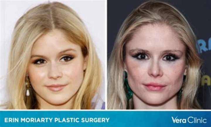 Erin Moriarty Before and After Enhancements: From Botox to Fillers and What Not?