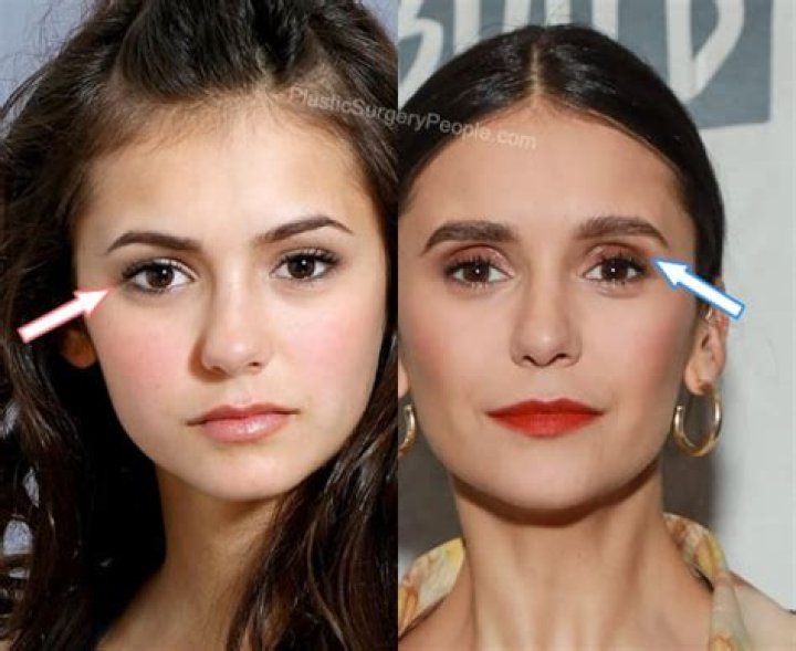 Nina Dobrev Plastic Surgery: Unveiling Her Journey with Plastic Surgery